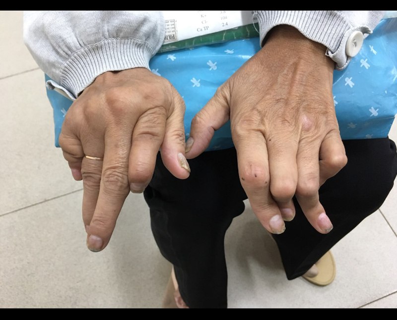 Dấu hiệu bệnh gout ở tay