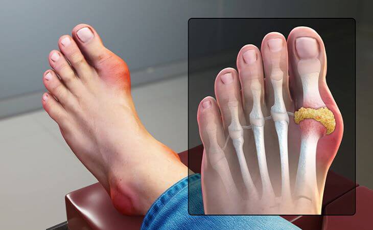 Ngón chân cái là vị trí dễ bị sưng đỏ do ảnh hưởng của bệnh gout