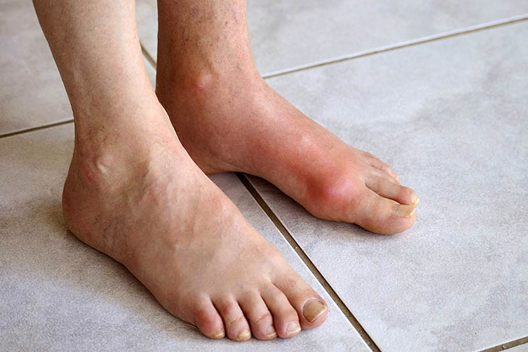 Bệnh gout ở chân và bàn chân