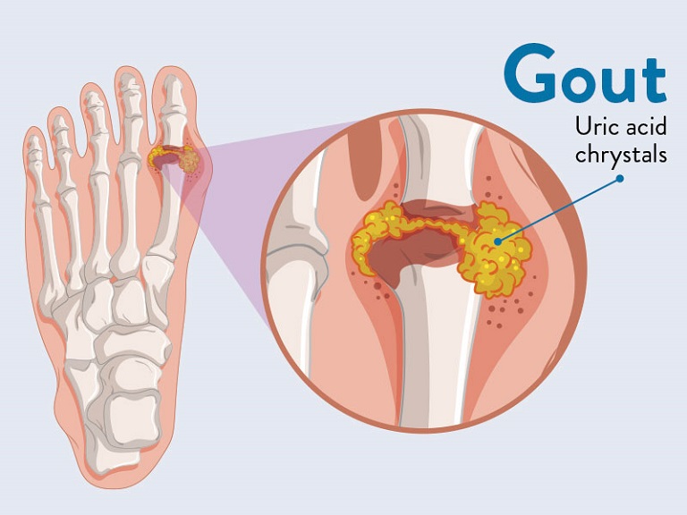 Gout và mối liên hệ với tạng can